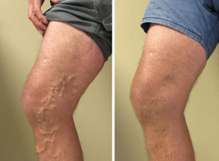 antes e despois da cirurxía